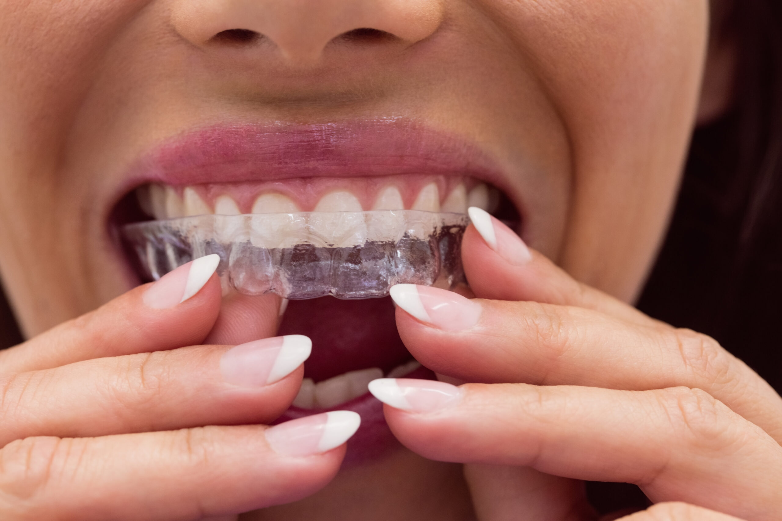close up of female patient wearing braces in dental clinic